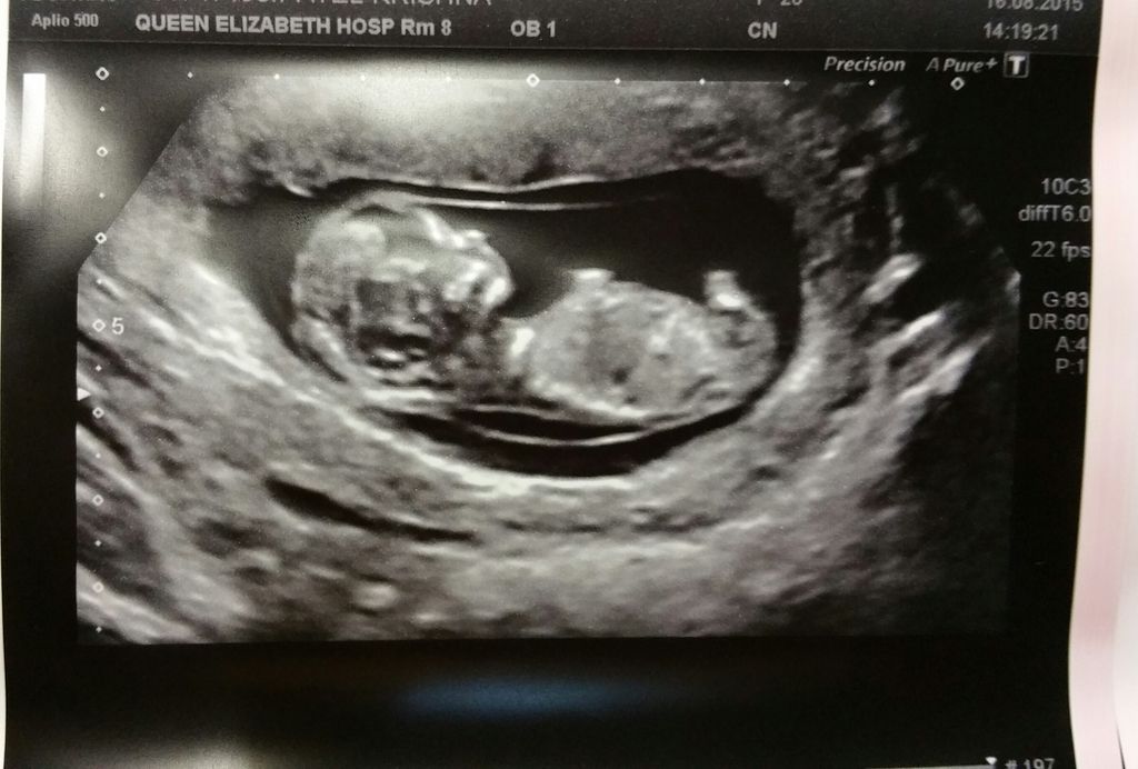 dating scan 2 weeks behind Dating scan 2 weeks behind: hi everyone firstly, congratulations to you all i had my first ultrasound this morning the doctor had assumed 7w 3d according to my. dating scan 2 weeks behind Dating scan 2 weeks behind: hi everyone firstly, congratulations to you all i had my first ultrasound this morning the doctor had assumed 7w 3d according to my.